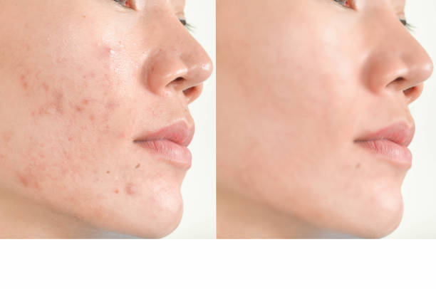 Acne treatment in Singapore